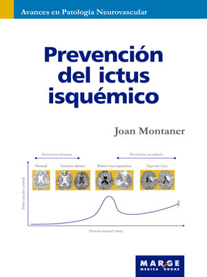 cover image of Prevención del ictus isquémico